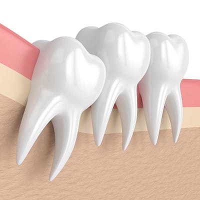 Painless Tooth Extraction: What to Expect in Dubai