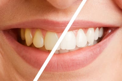 Brighten Your Smile with Teeth Whitening in Dubai