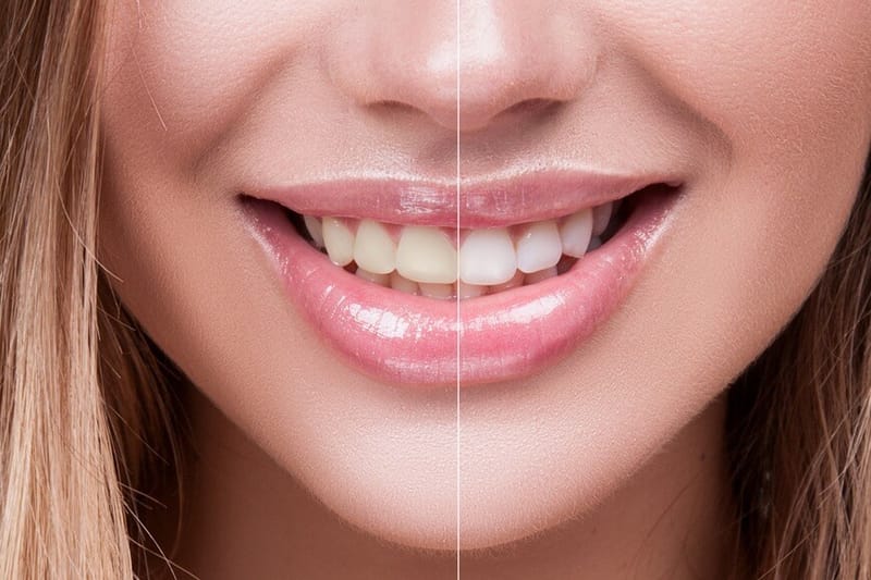 Teeth Whitening in Dubai: What You Need to Know Before You Go
