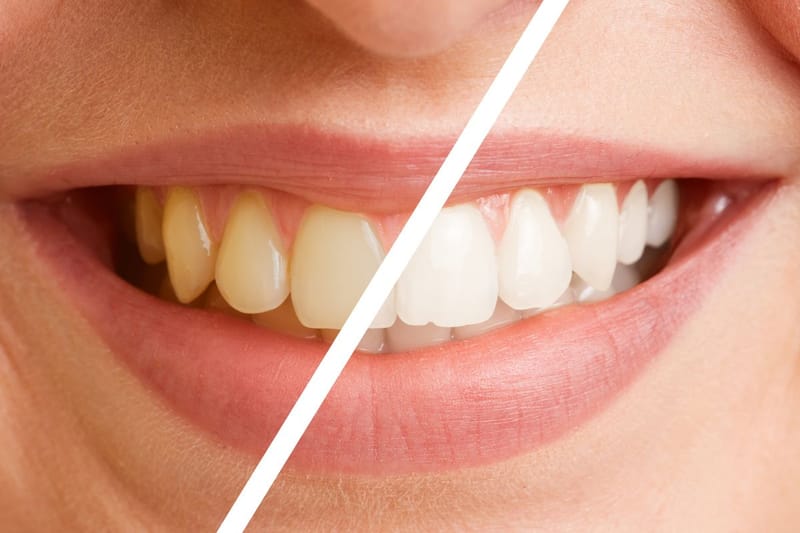 Discover the Best Teeth Whitening Cost in Dubai Today