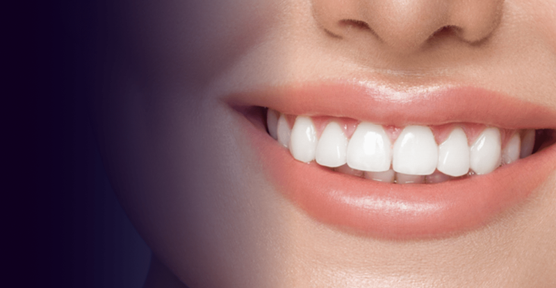 Pros and Cons of Teeth Whitening Cost in Dubai