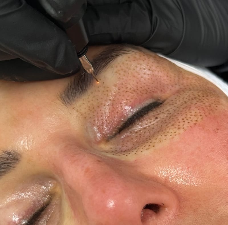 Plasma Pen for Loose Chin Skin: Does It Work?