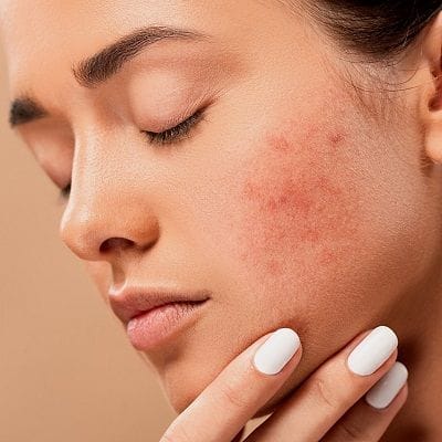 The Most Effective Melasma Treatment for Sun Damage