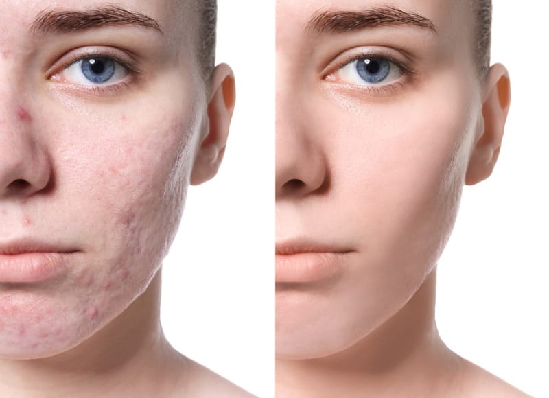 Brad Pitt’s Acne Scar Treatment: Do Men Benefit Differently?