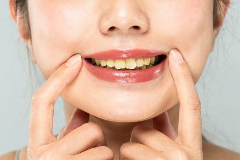 Can Correcting What Vitamin Deficiency Causes Yellow Teeth Help Glow?