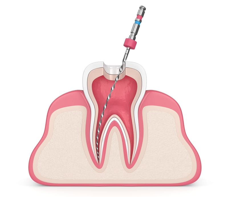 Root Canal Treatment for Cracked Teeth: What You Need