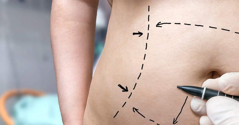 Unlock Confidence and Shape via Laser Liposuction Power
