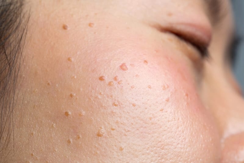 Warts Removal Treatments That Give Your Skin Its Smooth Future