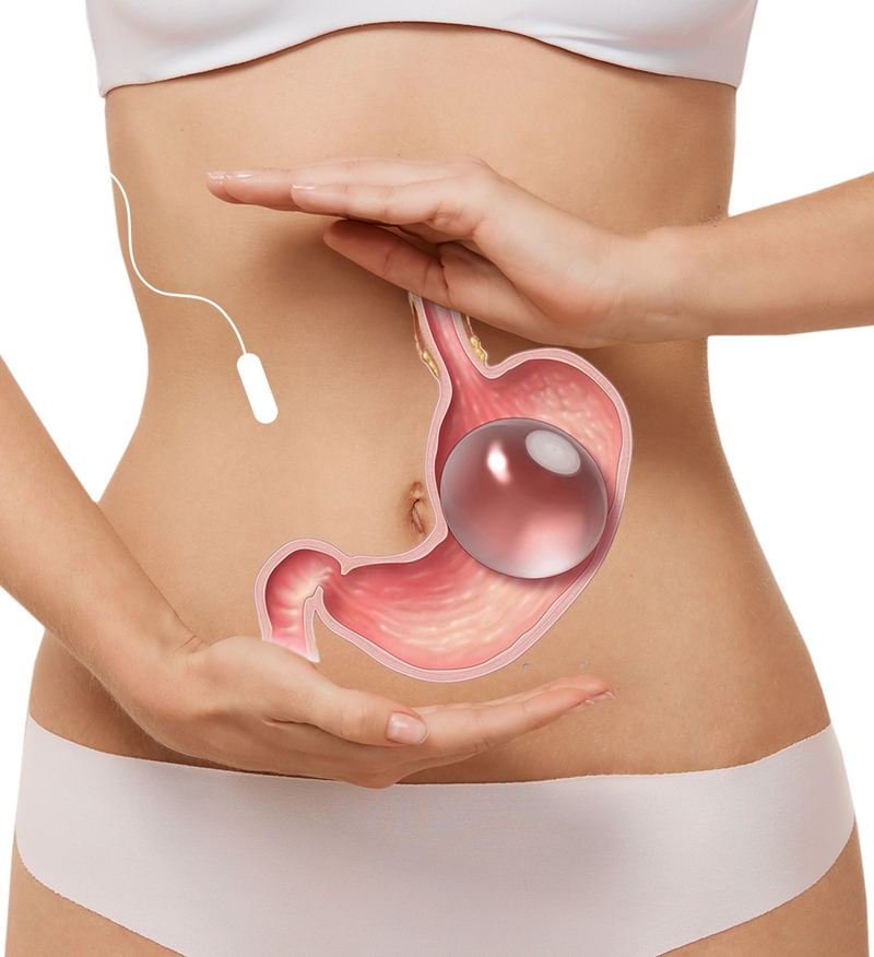 Reshape Your Life Confidently With Gastric Balloon Placement