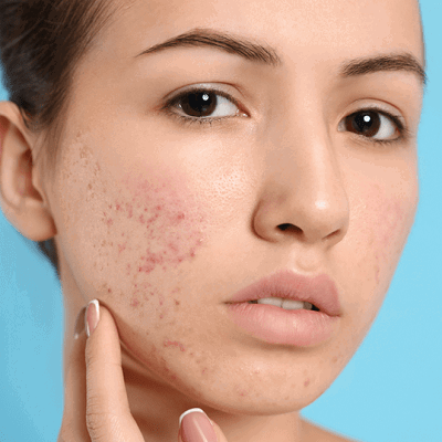 Say Goodbye to Breakouts with Advanced Acne Treatment Dubai