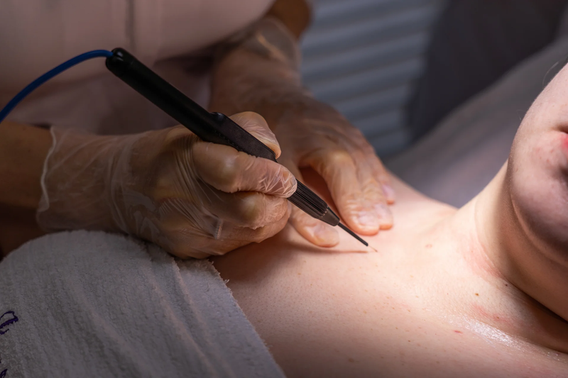 Transform Your Skin Game Instantly with Skin Tag Removal