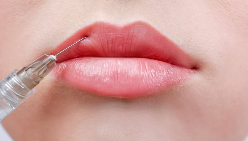 Russian Lip Fillers Trends Redefining the Art of Perfect Lips