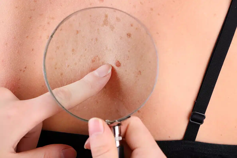 Discover Your True Glow Potential Using Skin Tag Removal