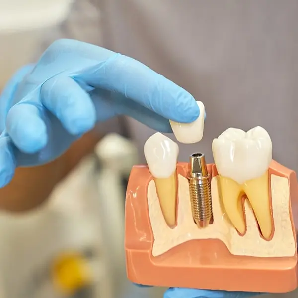 Elevate Daily Confidence Fast via Single Tooth Implant Cost
