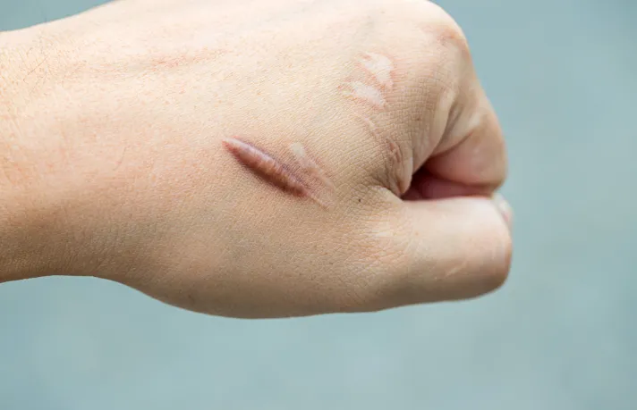 Scar Removal Dubai That Brings Flawless, Youthful Skin Fast