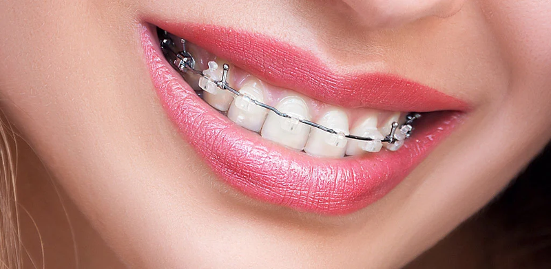 Everything About Teeth Braces Cost You Need to Know Right Now
