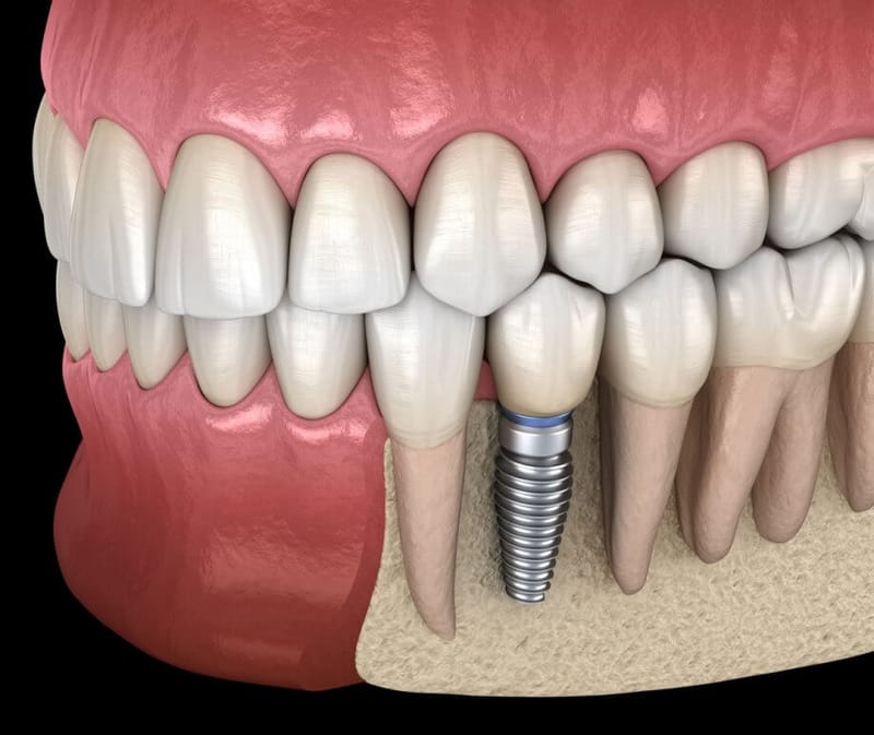 Single Tooth Implant Cost Makes Every Smile Truly Memorable Today