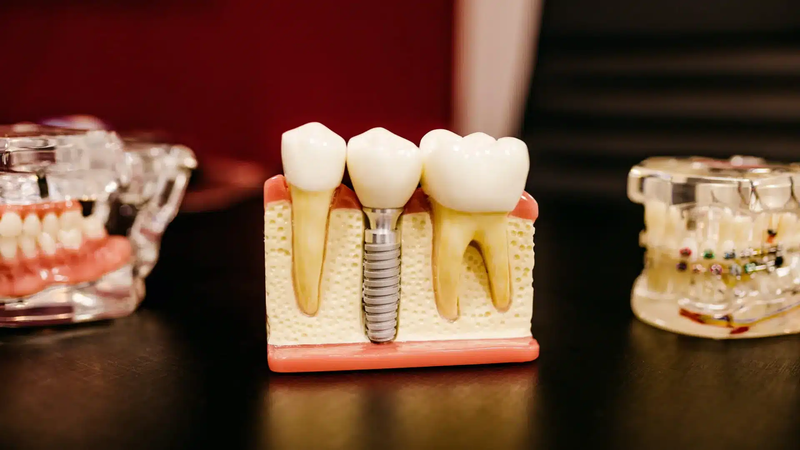 Step Forward Into Comfort With Tailored Single Tooth Implant Cost