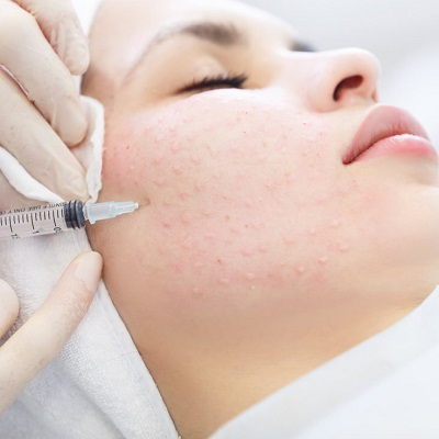 Reveal Your Skin’s Potential Fast with Mesotherapy cost Methods