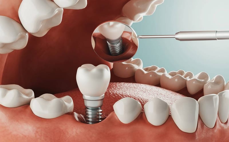 Refresh Your Smile Outlook Through Personalized Single Tooth Implant Cost