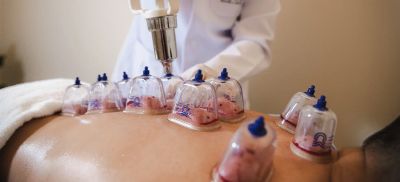 Feel Rejuvenated Instantly with Hijama Cupping Therapy Methods