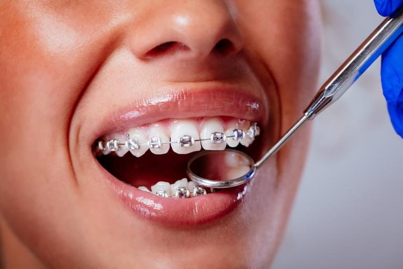Teeth Braces Costs Made Easy for Confident, Lasting Oral Health