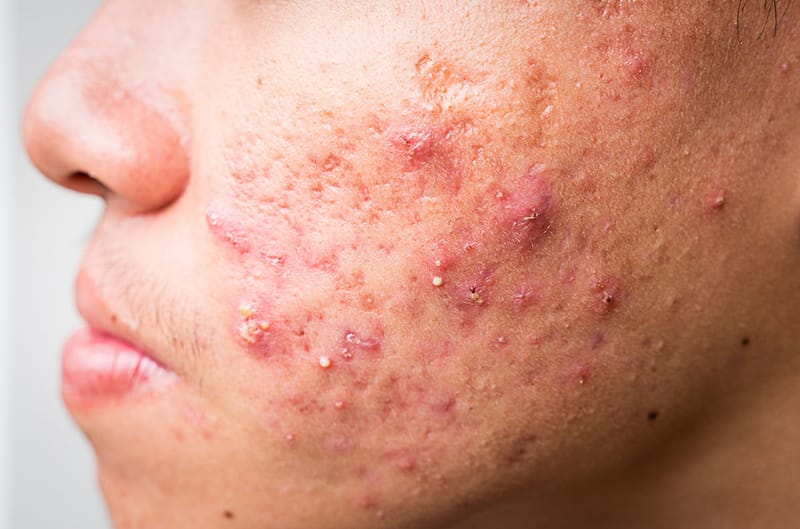 Reveal Skin Perfection Instantly with Acne Treatment Dubai