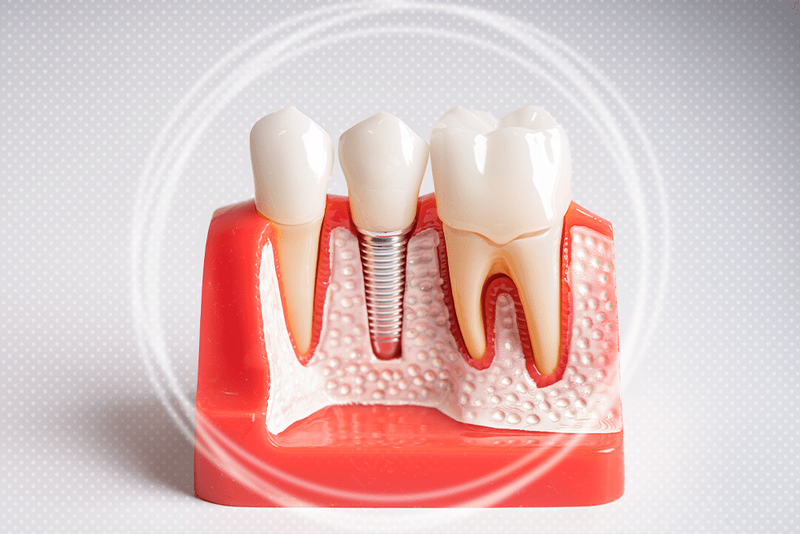 Reveal Bold Charm Today With Single Tooth Implant Cost Tips
