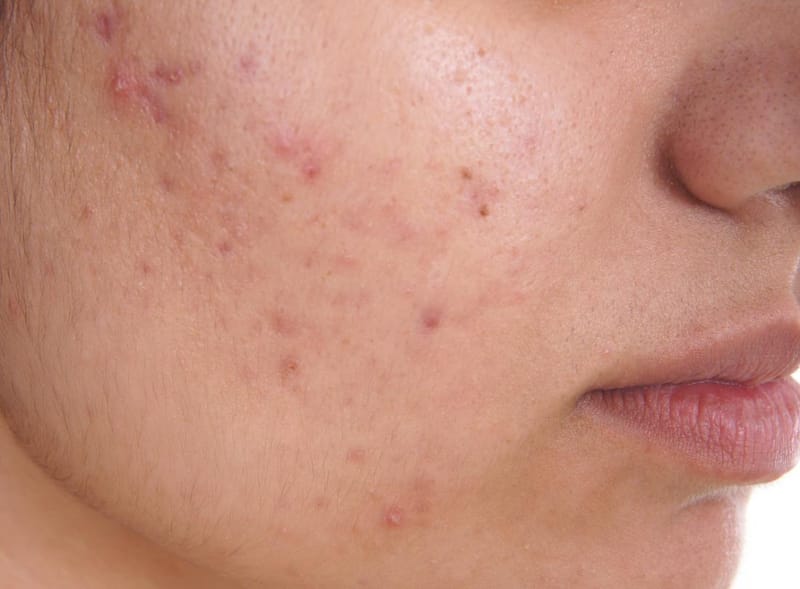 Brighten Your Skin Journey With Acne Treatment Dubai