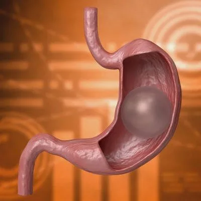 Transform Your Body with Gastric Balloon Placement for Lasting Results
