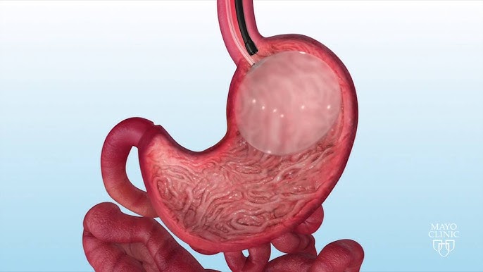Transform Your Body with Gastric Balloon Placement for Fast Results