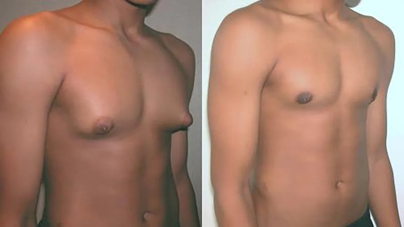 Reveal a New You Using Gynecomastia Surgery Cost Tips