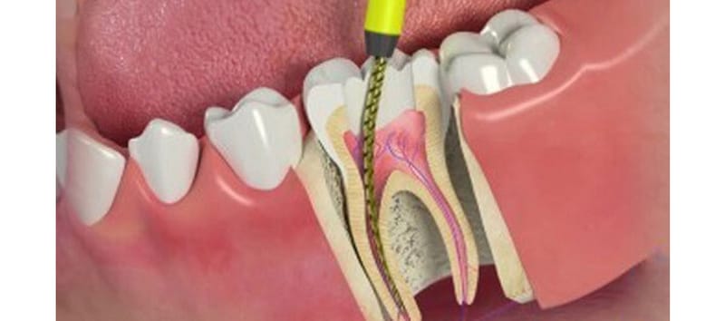 Root Canal Treatment That Saves Teeth and Enhances Oral Health