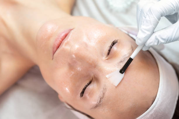 Boost Your Skin Glow Quickly with Chemical Peel Secrets
