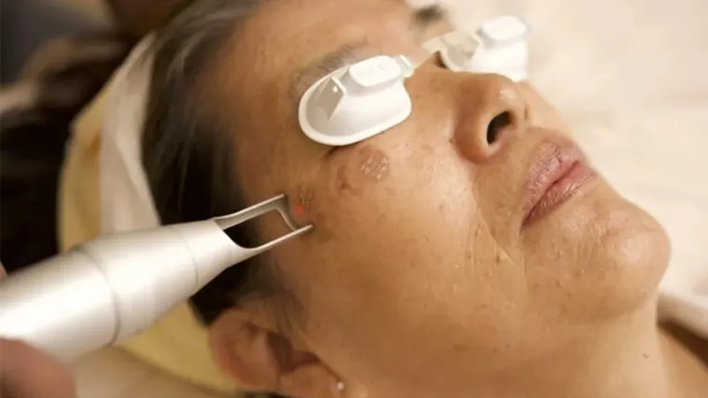 Picosure Laser Treatment for Smooth Complexion Enhancement Flow