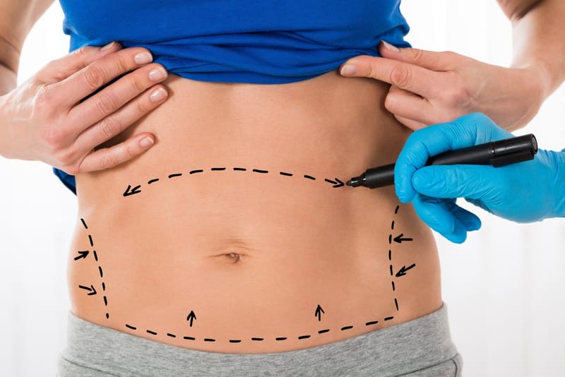 Tummy Tuck Helps You Reveal a Flatter and Firmer Midsection