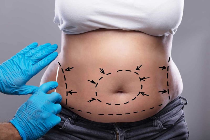 Tummy Tuck Reveals a Stronger Sleeker Body With Confidence