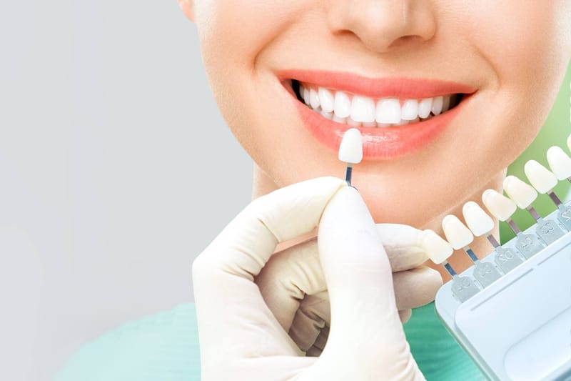 Dental Veneers Cost Secrets That Instantly Upgrade Your Smile
