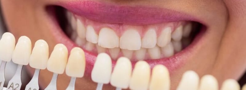 Dental Veneers Cost Secrets For Bright Confident Smiles