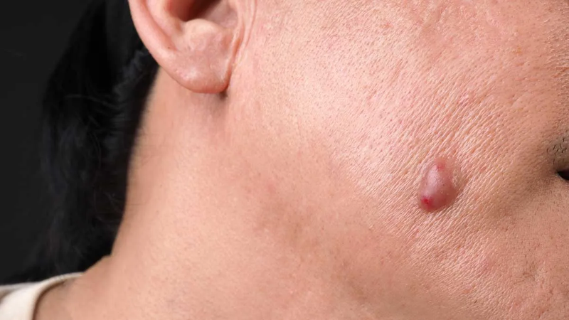 Powerful Keloid Treatment for scar renewal glow with lasting results