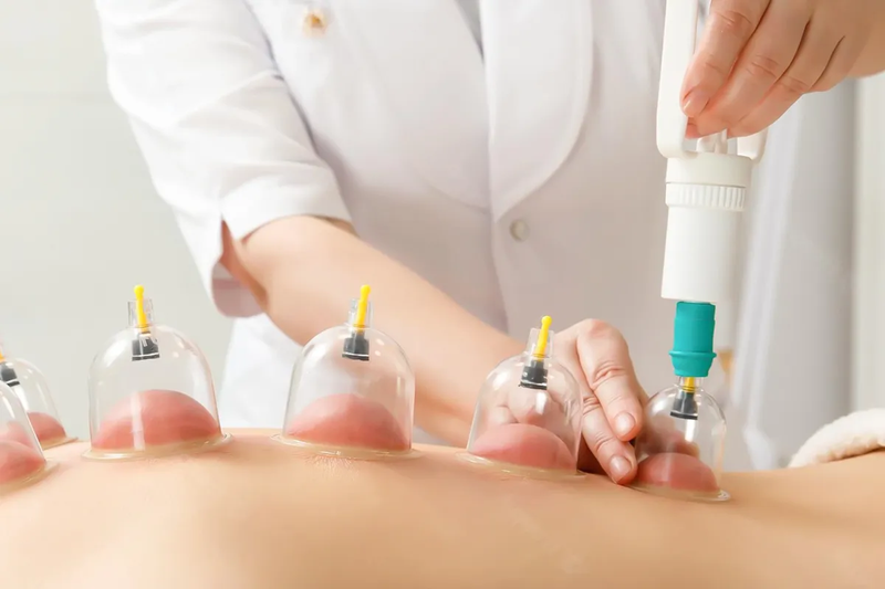 Hijama Cupping Therapy Radiance Boost for Holistic Strength Flow