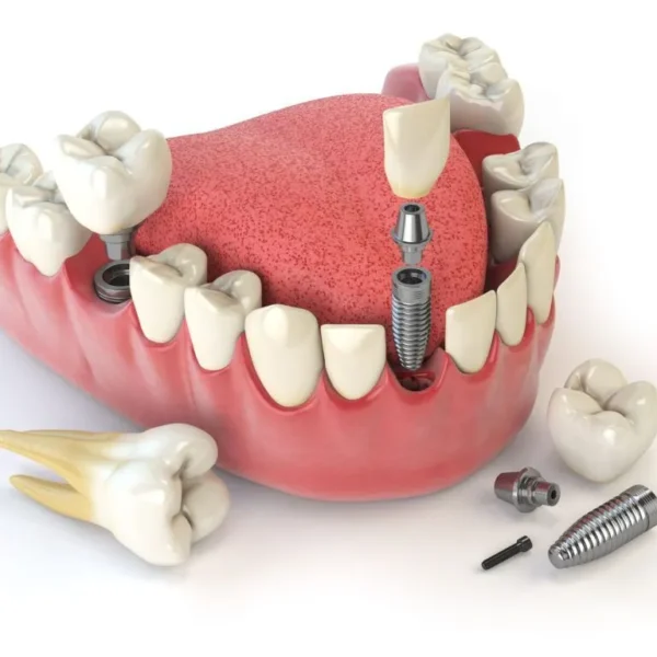 Unlock confident smiles using Dental implants vault secure smile rebuild system