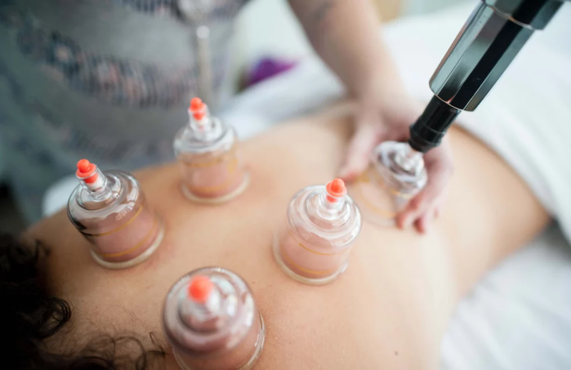 Hijama Cupping Therapy unlock ancient wellness secrets