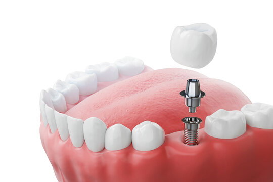 Dental implants restore powerful smile transformation today now