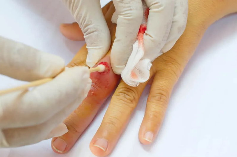 Incision and Drainage of Abscesses infection treatment support