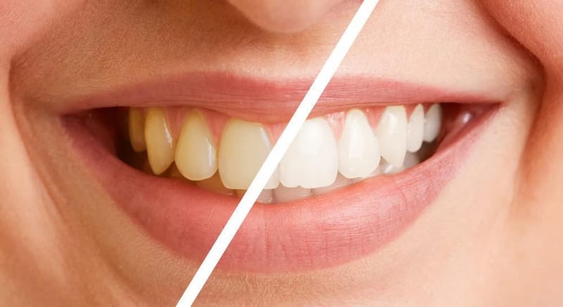 Radiant Shine Flow Teeth Whitening for Bold Bright Smile Energy