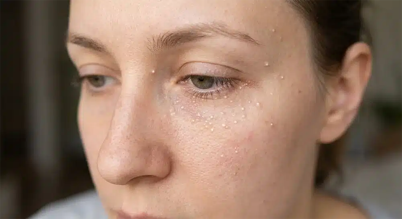 Clear Skin Energy Recharge With Milia Treatment Soft Glow Care
