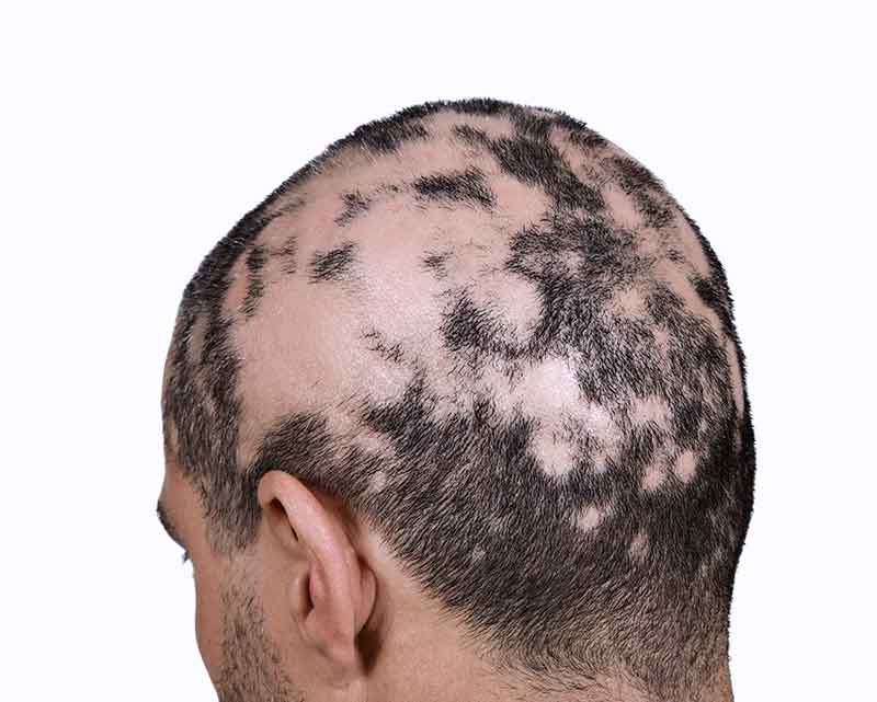 ALOPECIA