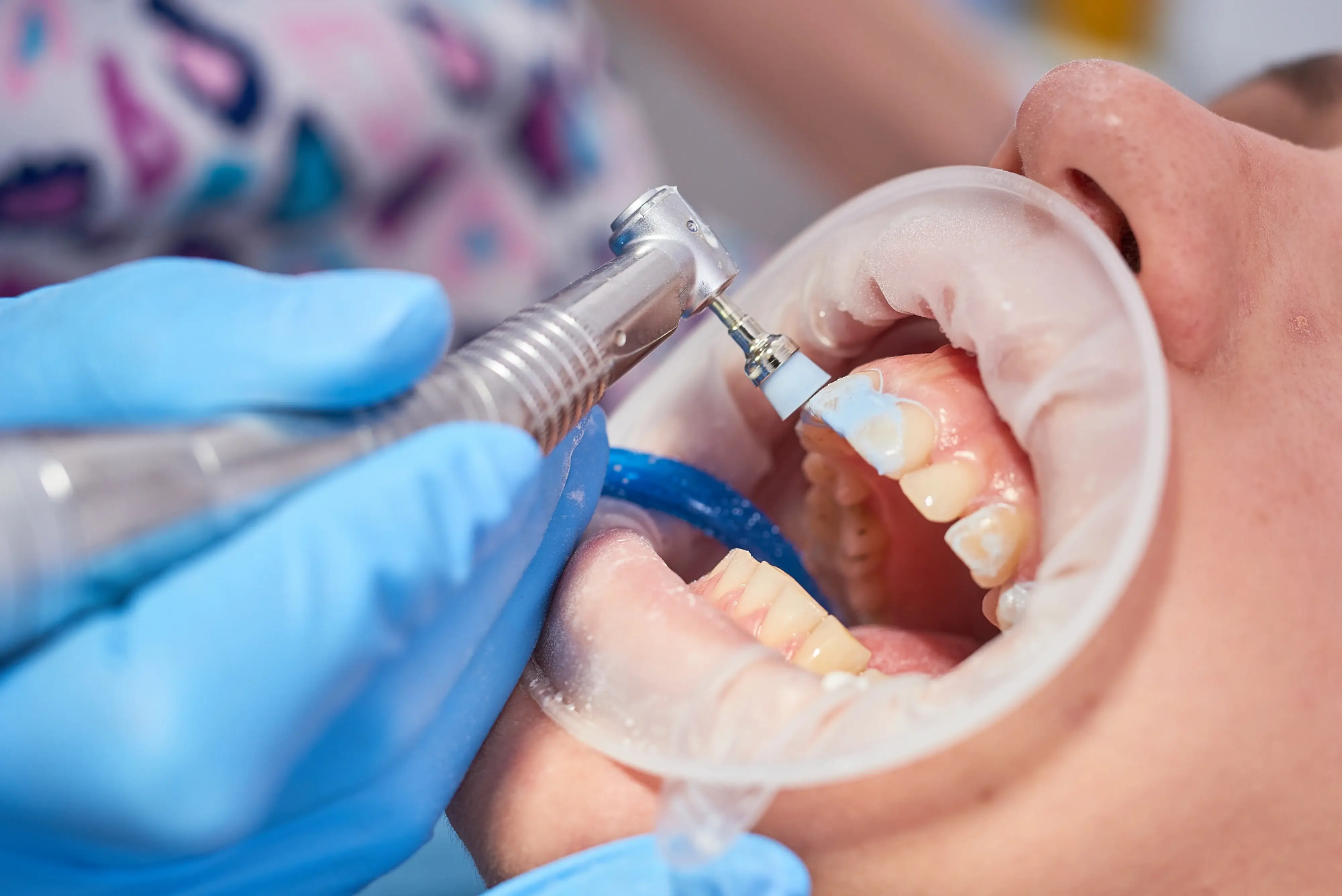 Clean Slate: How Teeth Cleaning Can Improve Your Oral Health