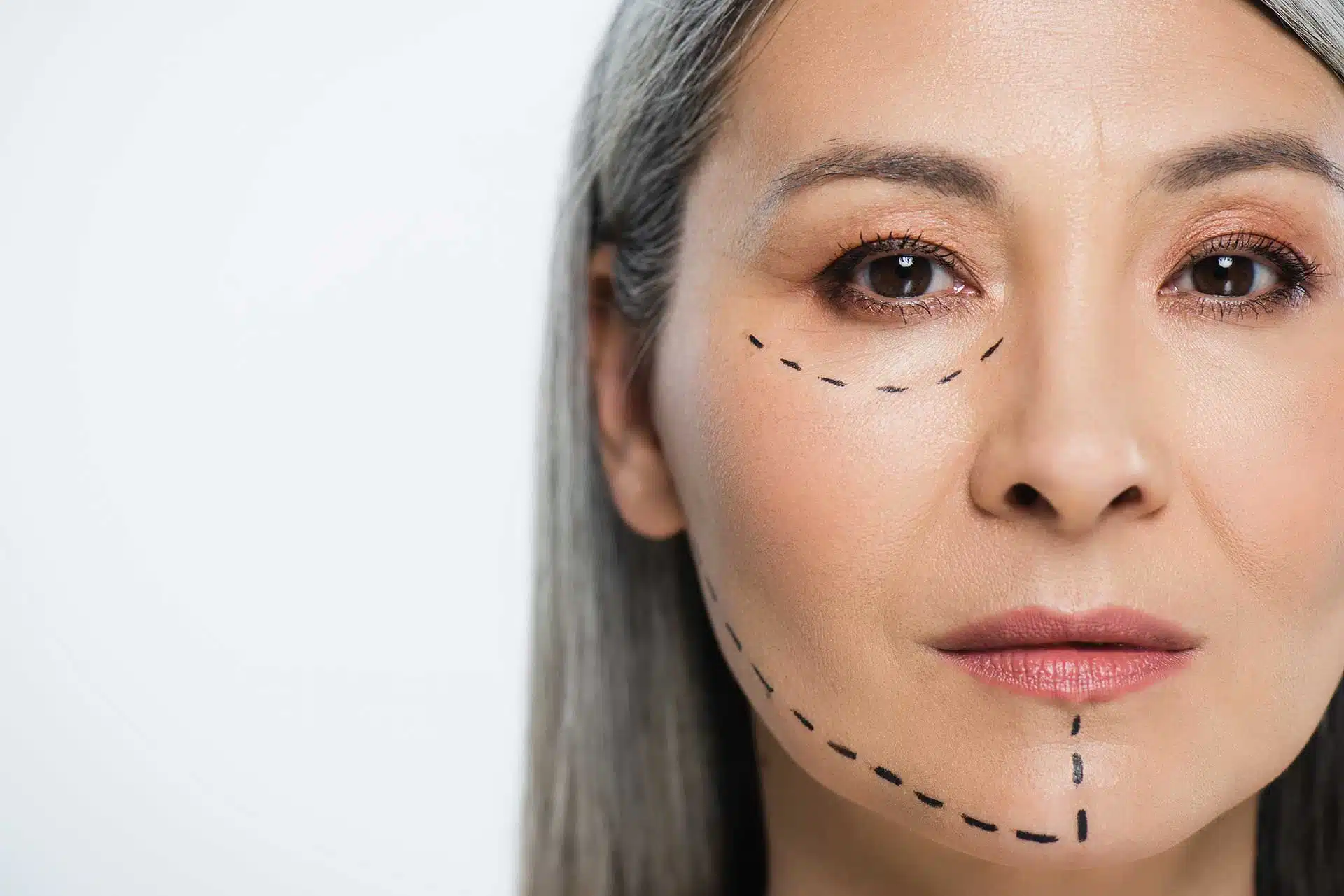 Why Endolift is Gaining Popularity in Aesthetic Medicine